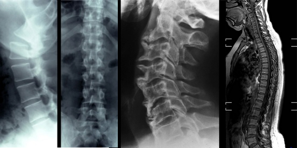spine